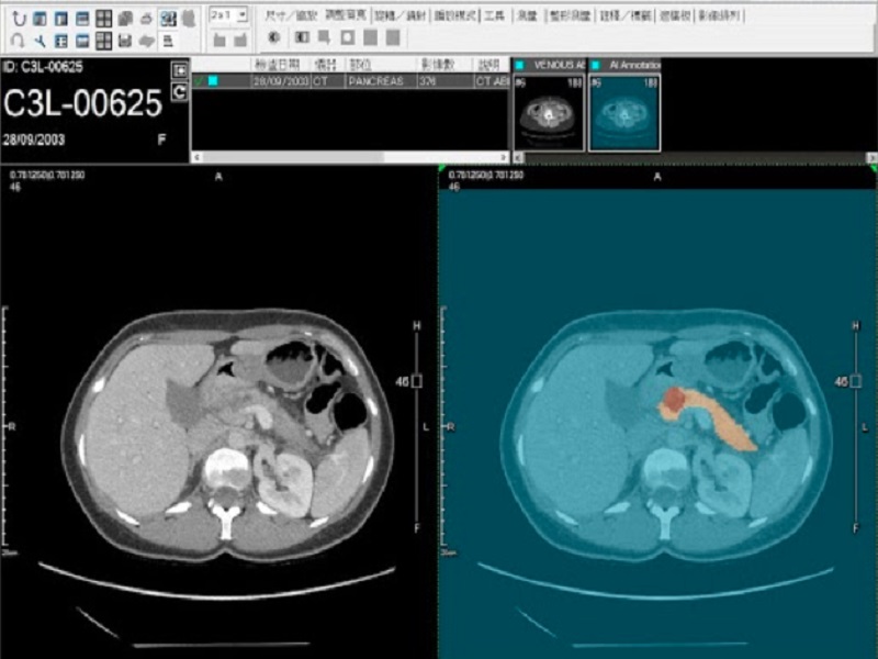 即時輔助判讀，左側為原始影像，右側為 AI 判讀結果，橘色區域為胰臟位置，紅色區域疑似為腫瘤