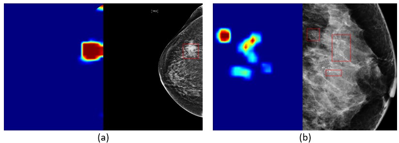 圖二　乳房病變偵測：(a)腫塊偵測的類別激活映射圖(左圖)和偵測結果(右圖)，和(b)疑似惡性鈣化偵測的類別激活映射圖(左圖)和偵測結果(右圖)